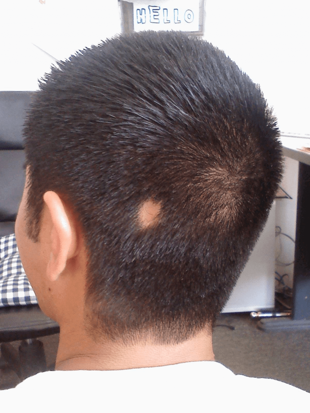 Children With Alopecia Day (Friday, April 14th, 2023) Children With Alopecia Day (Friday, April 14th, 2023)