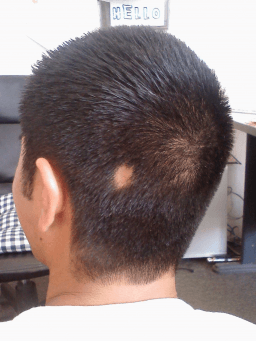 Children With Alopecia Day