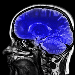 World Brain Tumor Day